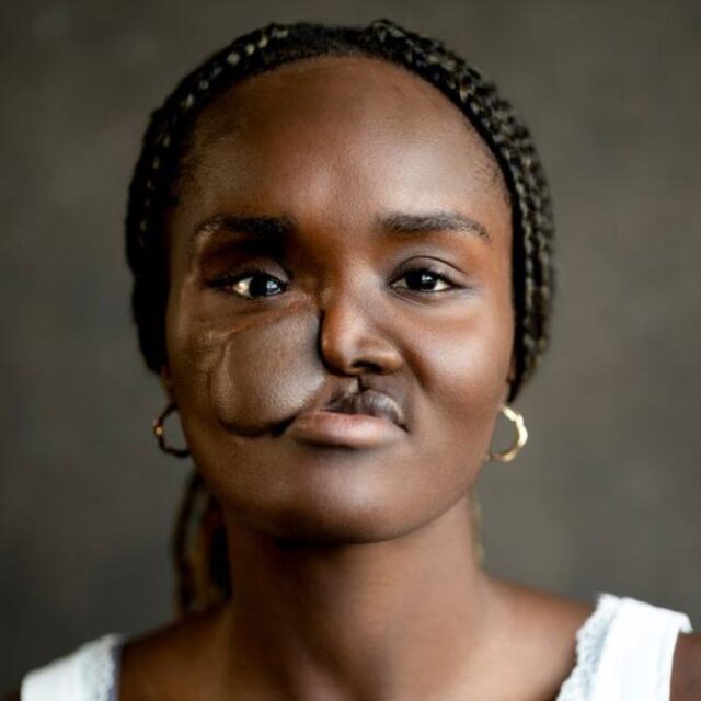 Woman with braided hair and hoop earrings, a patch of vitiligo visible on the left side of her face